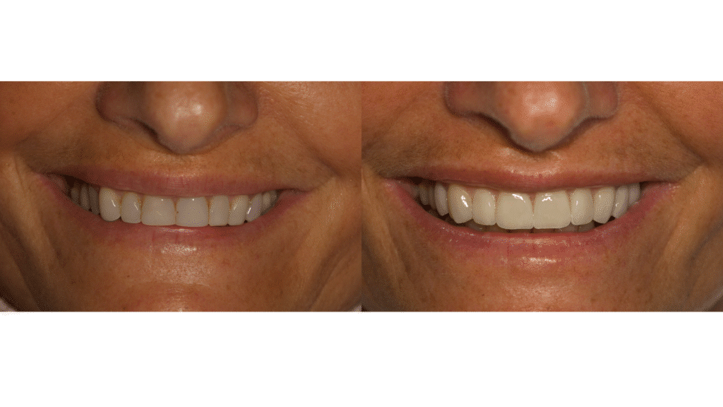 Limpieza dental en Santa Pola