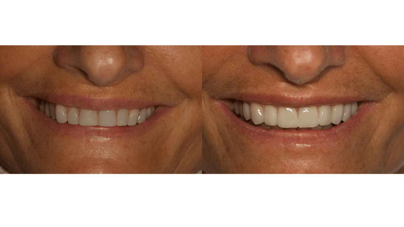 Limpieza dental en Santa Pola