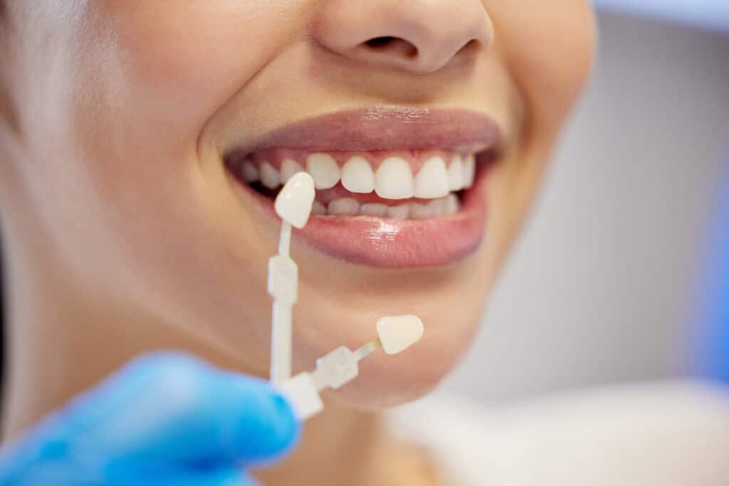 Blanqueamiento dental