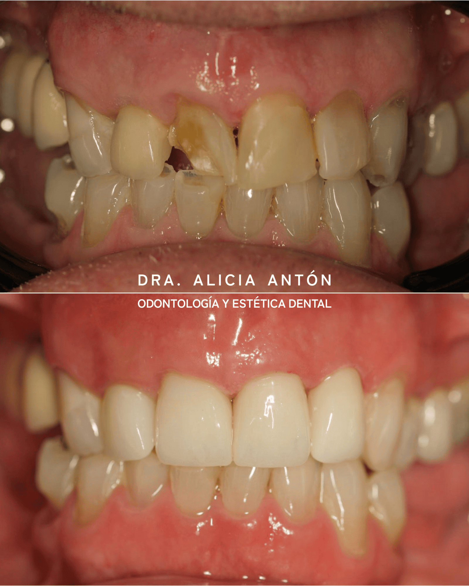 implante dental