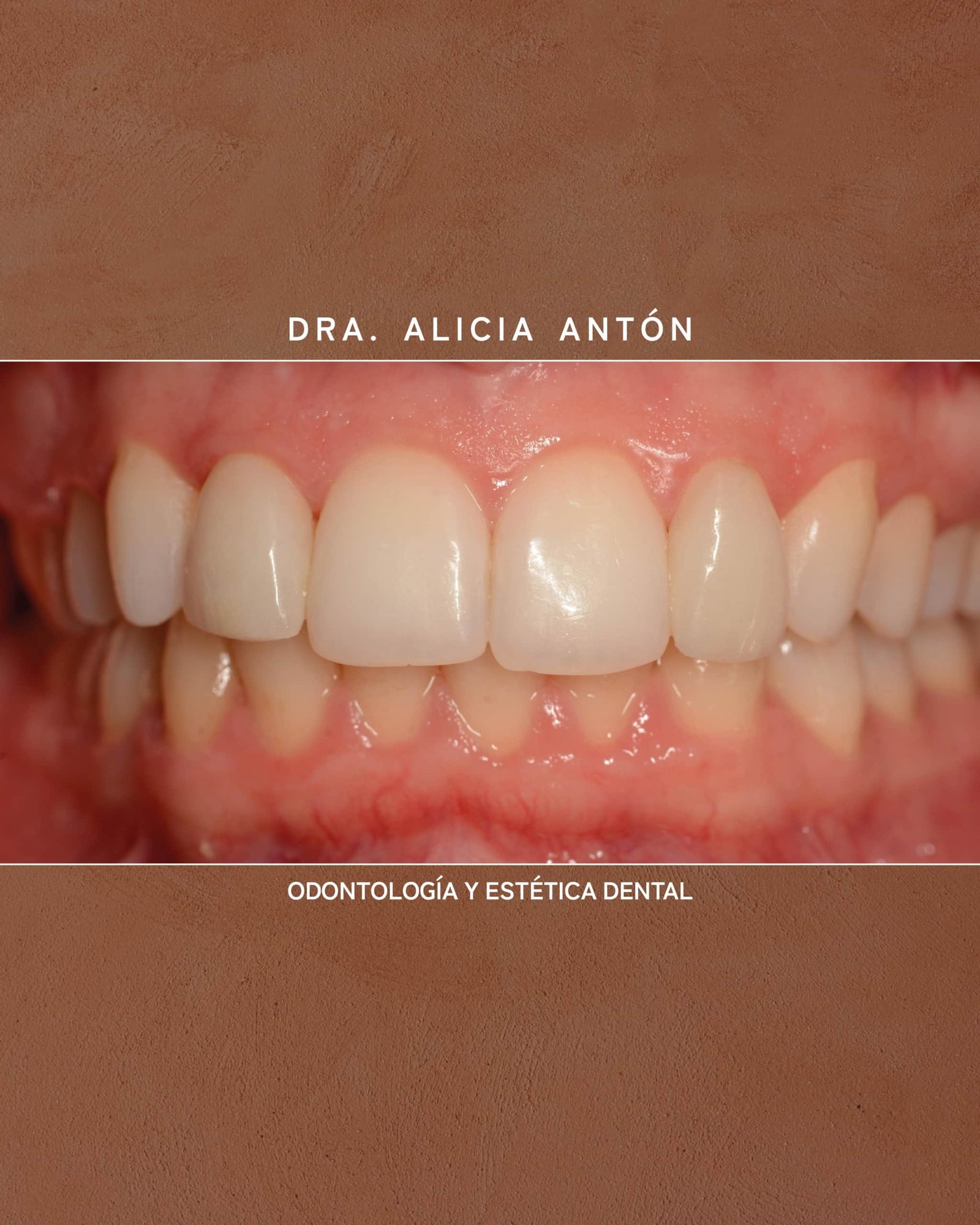 implantes dentales santa gran alacant y santa pola