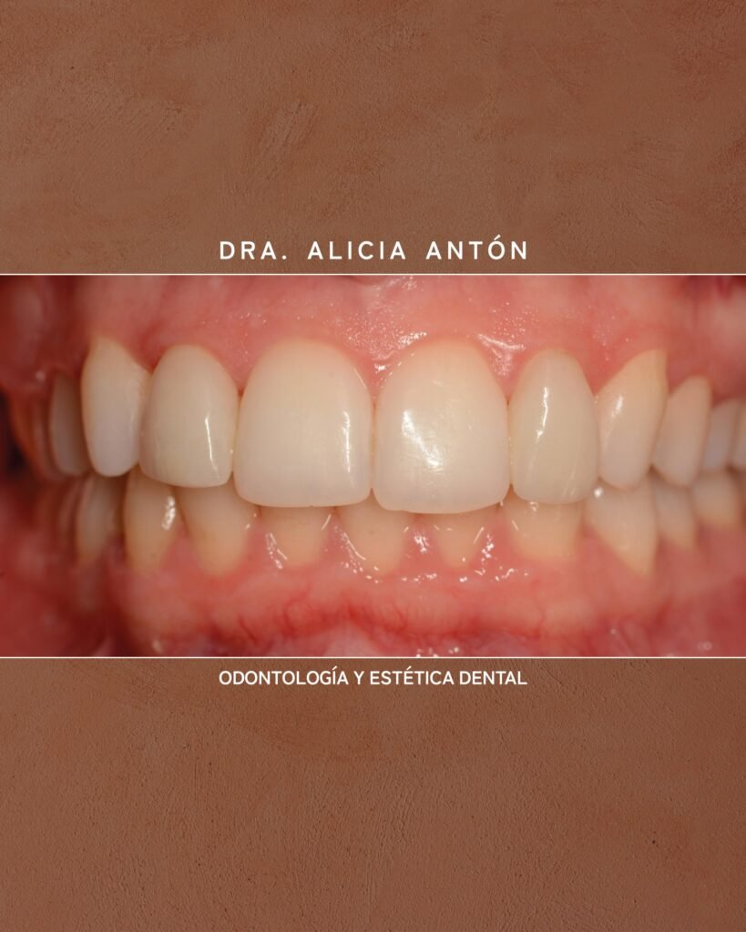 coronas dentales en gran alacant