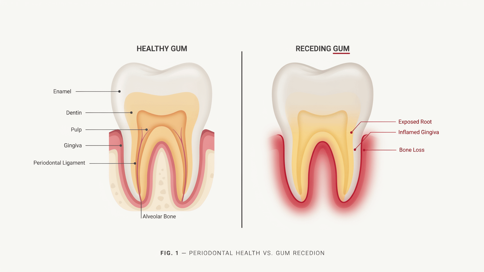 RECESION GINGIVAL inflamación de encías